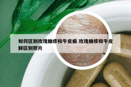 如何區(qū)別玫瑰糠疹和牛皮癬 玫瑰糠疹和牛皮鮮區(qū)別照片