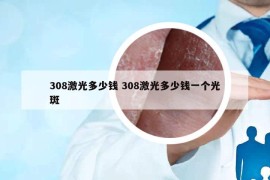 308激光多少錢(qián) 308激光多少錢(qián)一個(gè)光斑