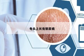 龜頭上長有銀屑病