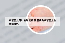 試管嬰兒可以去牛皮癬 銀屑病做試管嬰兒會有遺傳嗎
