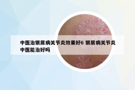中醫(yī)治銀屑病關(guān)節(jié)炎效果好6 銀屑病關(guān)節(jié)炎中醫(yī)能治好嗎