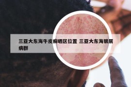 三亞大東海牛皮癬曬區(qū)位置 三亞大東海銀屑病群