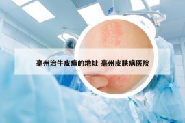 亳州治牛皮癬的地址 亳州皮膚病醫(yī)院