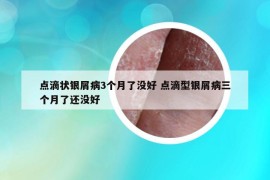 點(diǎn)滴狀銀屑病3個月了沒好 點(diǎn)滴型銀屑病三個月了還沒好