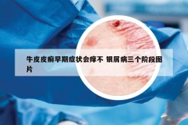 牛皮皮癬早期癥狀會癢不 銀屑病三個階段圖片