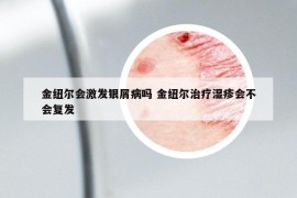 金紐爾會激發(fā)銀屑病嗎 金紐爾治療濕疹會不會復(fù)發(fā)