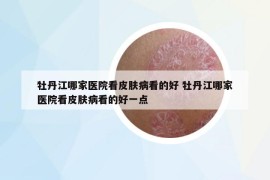 牡丹江哪家醫(yī)院看皮膚病看的好 牡丹江哪家醫(yī)院看皮膚病看的好一點(diǎn)