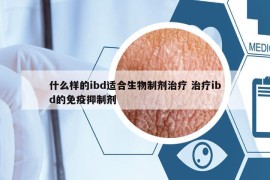什么樣的ibd適合生物制劑治療 治療ibd的免疫抑制劑