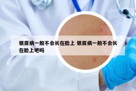 銀屑病一般不會(huì)長(zhǎng)在臉上 銀屑病一般不會(huì)長(zhǎng)在臉上吧嗎