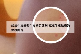 紅皮牛皮癬和牛皮癬的區(qū)別 紅皮牛皮膚癬的癥狀圖片