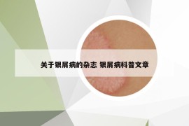 關(guān)于銀屑病的雜志 銀屑病科普文章