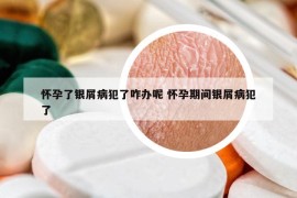 懷孕了銀屑病犯了咋辦呢 懷孕期間銀屑病犯了