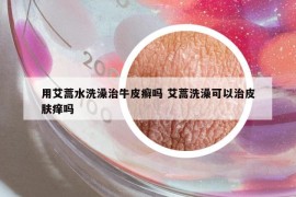 用艾蒿水洗澡治牛皮癬嗎 艾蒿洗澡可以治皮膚癢嗎