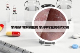 常州最好銀屑病醫(yī)院 常州哪家醫(yī)院看皮膚病