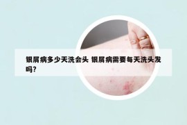 銀屑病多少天洗會(huì)頭 銀屑病需要每天洗頭發(fā)嗎?