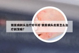 銀屑病剃頭治療好不好 銀屑病頭皮屑怎么治療剃發(fā)嘛?