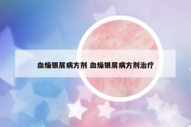 血燥銀屑病方劑 血燥銀屑病方劑治療