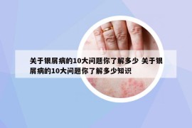 關(guān)于銀屑病的10大問題你了解多少 關(guān)于銀屑病的10大問題你了解多少知識(shí)