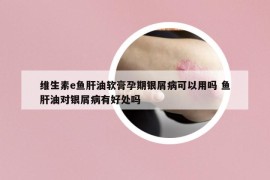 維生素e魚(yú)肝油軟膏孕期銀屑病可以用嗎 魚(yú)肝油對(duì)銀屑病有好處嗎