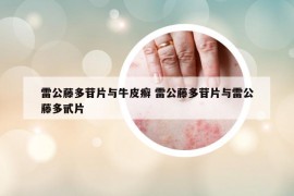 雷公藤多苷片與牛皮癬 雷公藤多苷片與雷公藤多甙片