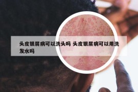 頭皮銀屑病可以洗頭嗎 頭皮銀屑病可以用洗發(fā)水嗎