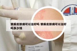 銀癬皮膚病可以治好嗎 銀癬皮膚病可以治好嗎多少錢