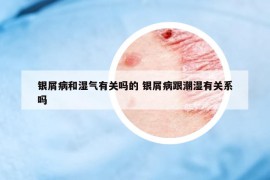 銀屑病和濕氣有關(guān)嗎的 銀屑病跟潮濕有關(guān)系嗎