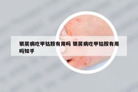 銀屑病吃甲鈷胺有用嗎 銀屑病吃甲鈷胺有用嗎知乎