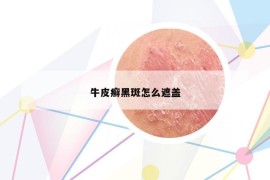 牛皮癬黑斑怎么遮蓋
