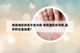 銀屑病皮損變平變大癢 銀屑病皮損發(fā)癢,是好轉(zhuǎn)還是加重?