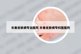 長春皮膚病專治醫(yī)院 長春皮膚病?？漆t(yī)醫(yī)院