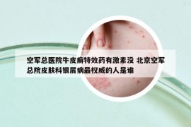 空軍總醫(yī)院牛皮癬特效藥有激素沒 北京空軍總院皮膚科銀屑病最權(quán)威的人是誰