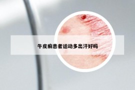 牛皮癬患者運(yùn)動(dòng)多出汗好嗎