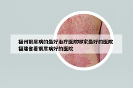 福州銀屑病的最好治療醫(yī)院哪家最好的醫(yī)院 福建省看銀屑病好的醫(yī)院