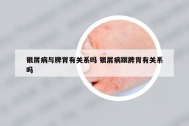 銀屑病與脾胃有關(guān)系嗎 銀屑病跟脾胃有關(guān)系嗎