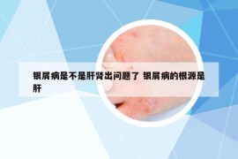 銀屑病是不是肝腎出問題了 銀屑病的根源是肝