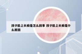 孩子臉上長(zhǎng)癬是怎么回事 孩子臉上長(zhǎng)癬是什么原因