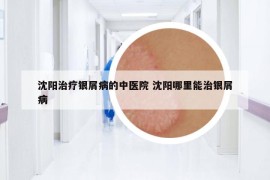 沈陽治療銀屑病的中醫(yī)院 沈陽哪里能治銀屑病