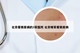 北京看銀屑病的3家醫(yī)院 北京哪家看銀屑病