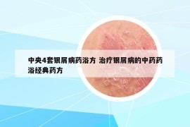 中央4套銀屑病藥浴方 治療銀屑病的中藥藥浴經(jīng)典藥方