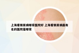 上?？淬y屑病哪家醫(yī)院好 上?？淬y屑病最有名的醫(yī)院是哪家