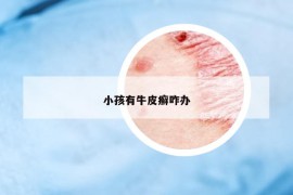 小孩有牛皮癬咋辦