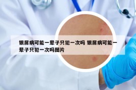 銀屑病可能一輩子只犯一次嗎 銀屑病可能一輩子只犯一次嗎圖片