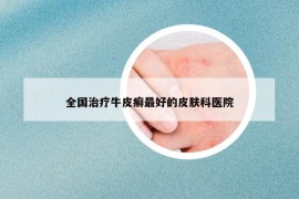 全國治療牛皮癬最好的皮膚科醫(yī)院