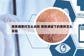 銀屑病黑印怎么去除 銀屑病留下的黑斑怎么去除