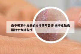 南寧哪家牛皮癬的治療醫(yī)院最好 南寧皮膚病醫(yī)院十大排名榜
