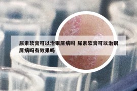 尿素軟膏可以治銀屑病嗎 尿素軟膏可以治銀屑病嗎有效果嗎