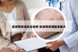 臉部銀屑病自愈貼吧 臉部銀屑病越來越大