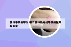 吉林牛皮癬哪治得好 吉林最好的牛皮癬醫(yī)院是哪家