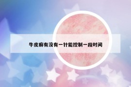 牛皮癬有沒有一針能控制一段時間